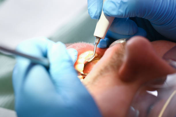 Best Emergency Wisdom Teeth Removal in Security Widefield, CO